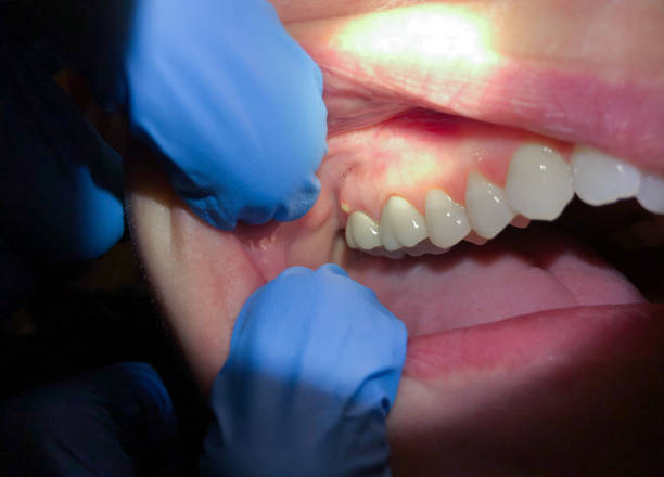 Best Emergency Tooth Extraction in Fredericktown, OH